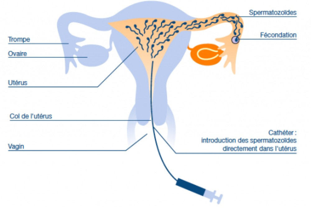 insémination intra-utérine IIU