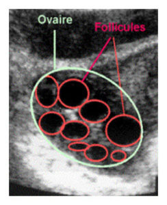 stimulation de l'ovulation