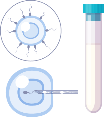 Fécondation in vitro Fécondation in vitro