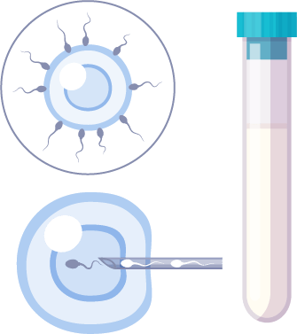 Fécondation in vitro