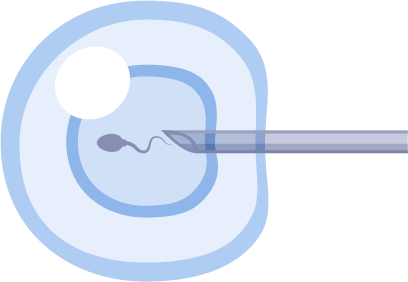 injection intracytoplasmique